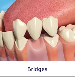 Bridges